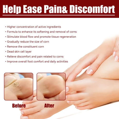 3917adaddf996d51044b6d7f31f588a1.jpg_2200x2200q80.jpg_ সাউথ মুন ফুট কর্ন রিমুভাল জেল (South Moon Foot Corn Removal Gel)