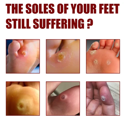 bcec42f16088eccdeb1406ffda8b94f3.jpg_2200x2200q80.jpg_ সাউথ মুন ফুট কর্ন রিমুভাল জেল (South Moon Foot Corn Removal Gel)