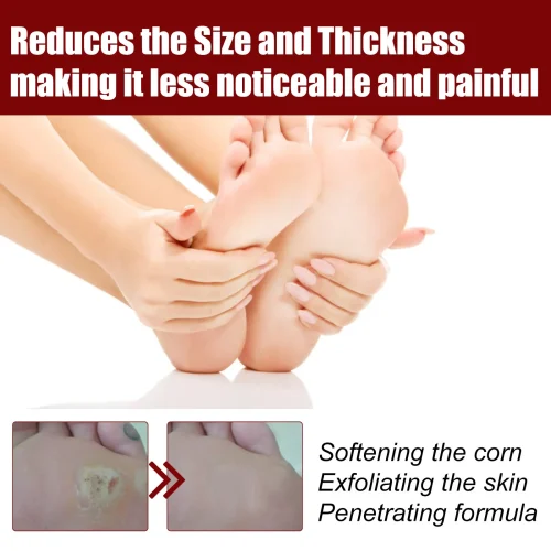 c1a4235d27a0abd29cc0c54686fa01fa.jpg_2200x2200q80.jpg_ সাউথ মুন ফুট কর্ন রিমুভাল জেল (South Moon Foot Corn Removal Gel)